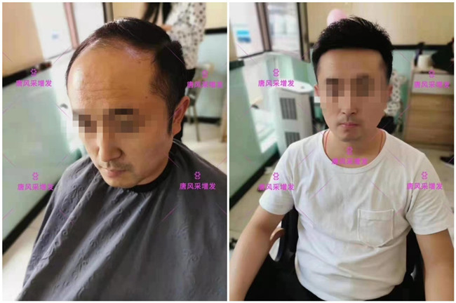 中老年頭頂假發(fā)片價格 唐風采客戶