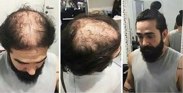 禿頂發(fā)型設(shè)計 禿頂發(fā)型設(shè)計