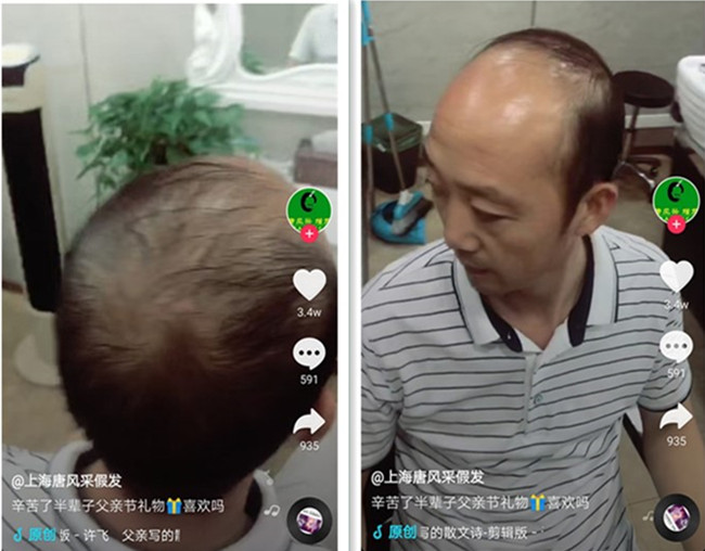 頭頂局部假發(fā) 唐風(fēng)采客戶案例