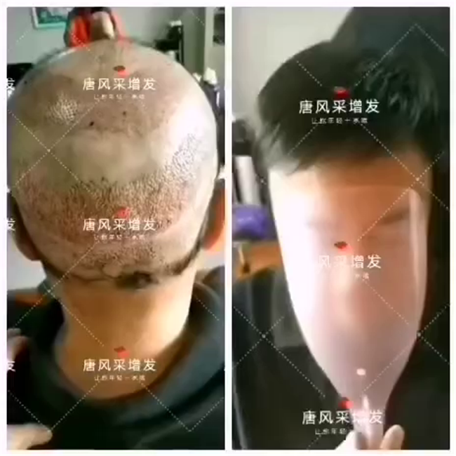 脫發(fā) 植發(fā)失敗后選擇唐風采假發(fā)