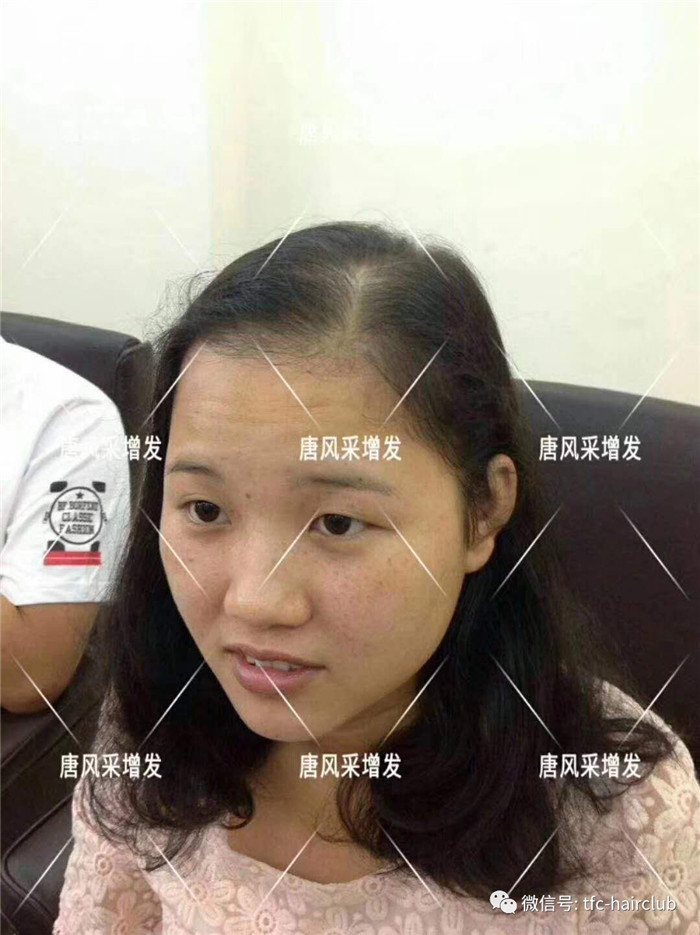 無(wú)痕補(bǔ)發(fā)看得出是假發(fā)嗎 唐風(fēng)采客戶(hù)增發(fā)前