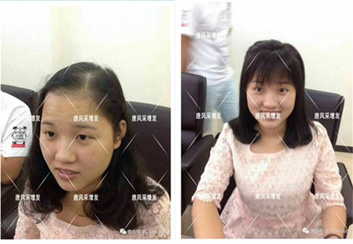無(wú)痕補(bǔ)發(fā)看得出是假發(fā)嗎 唐風(fēng)采客戶(hù)增發(fā)后
