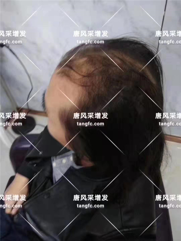 假發(fā)補發(fā)片專賣店 唐風采客戶小Y增發(fā)前