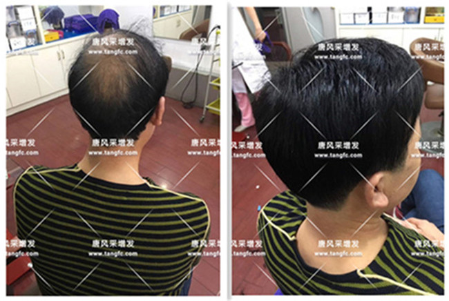 老年人透氣假發(fā) 真人案例展示