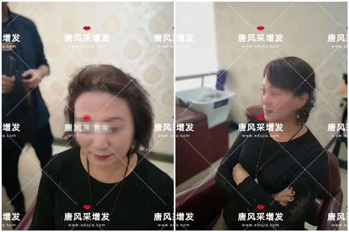 中老年頭發(fā)少 唐風(fēng)采客戶錢阿姨增發(fā)前后對(duì)比