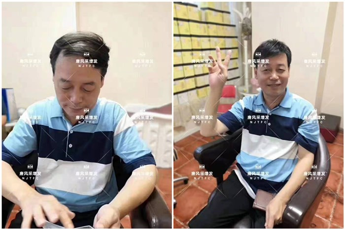 頭頂假發(fā)片 唐風(fēng)采客戶(hù)李先生增發(fā)前后