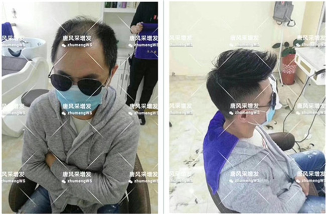 頭頂粘貼假發(fā)片 唐風(fēng)采客戶章先生增發(fā)后