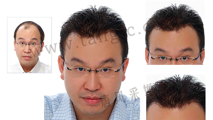 隱形發(fā)套 脫發(fā)原因有很多種