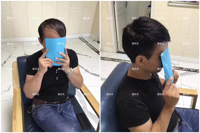 假發(fā)戴了會掉嗎 \