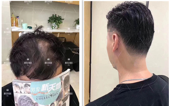 假發(fā)戴了會掉嗎 \