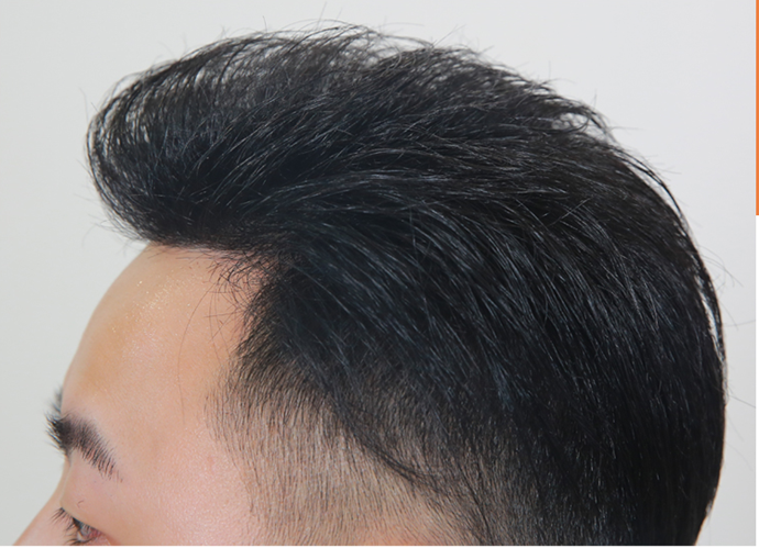 局部頭頂補(bǔ)發(fā) \