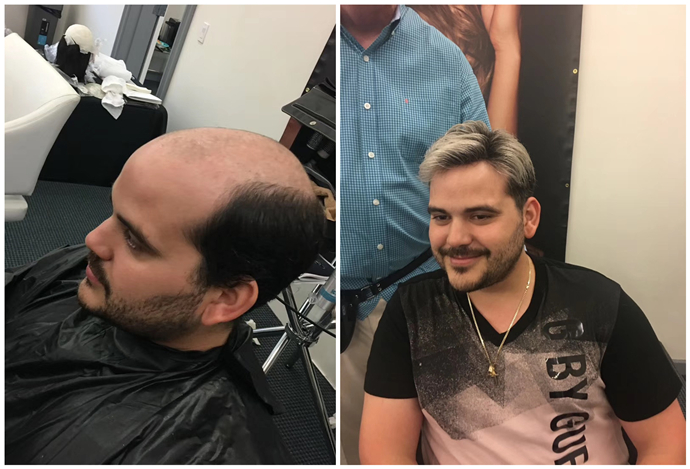 禿頂戴假發(fā)教程 \