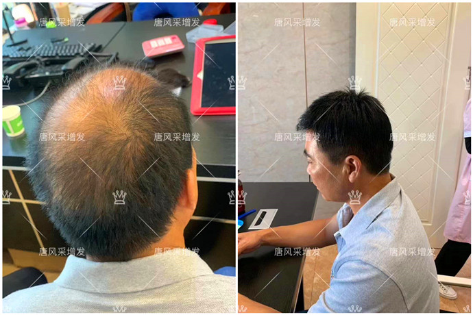 頭頂補發(fā)片買哪種好 \