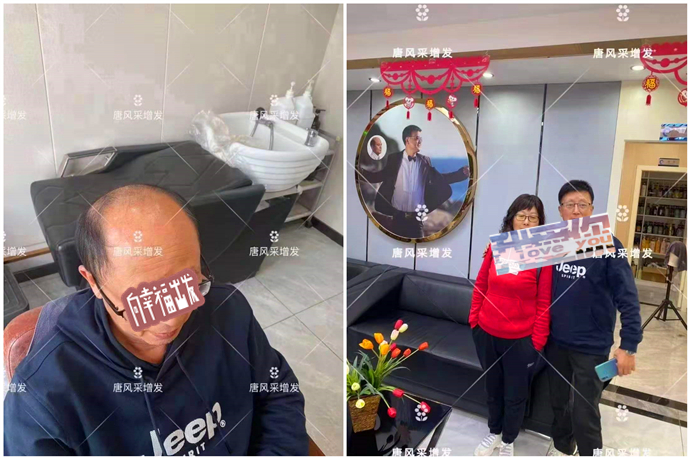 頭頂補發(fā)片買哪種好 \