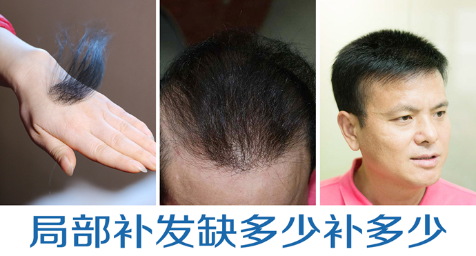 頭發(fā)太少做隱形增發(fā) \