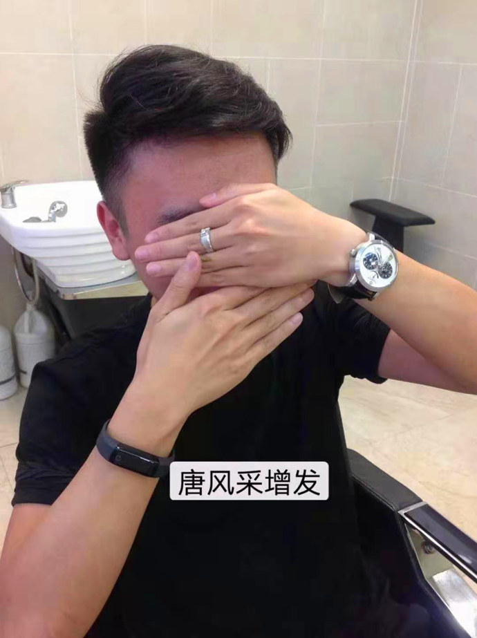 頭發(fā)太少做隱形增發(fā) \