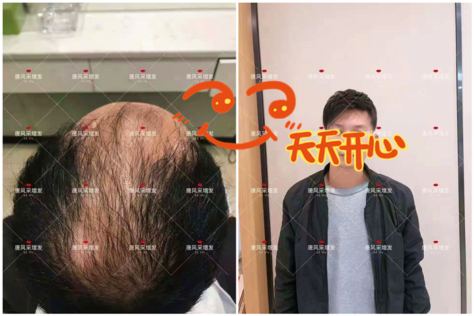 假發(fā)私人定制好在哪 \