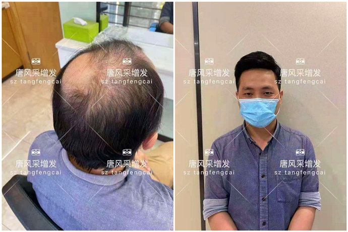 脫發(fā)人的中年危機(jī) \