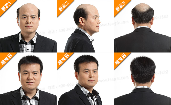 禿頂戴假發(fā)方便嗎 \