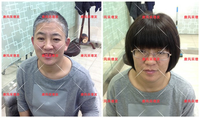 禿頂戴假發(fā)方便嗎 \