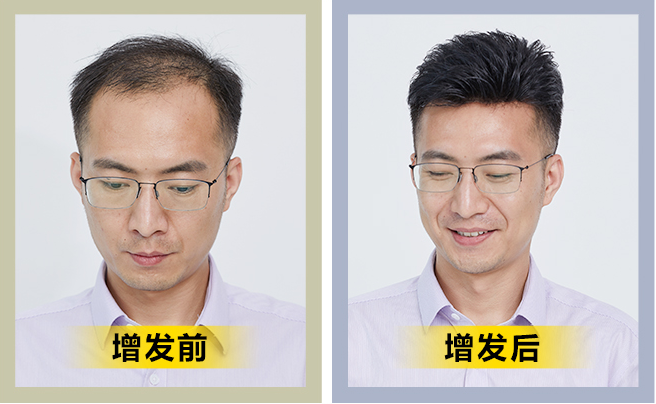 有頭發(fā)沒頭發(fā) \