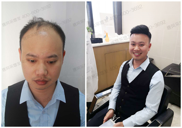 隱形假發(fā)能用多久 \