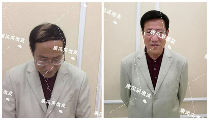 定制隱形假發(fā) \