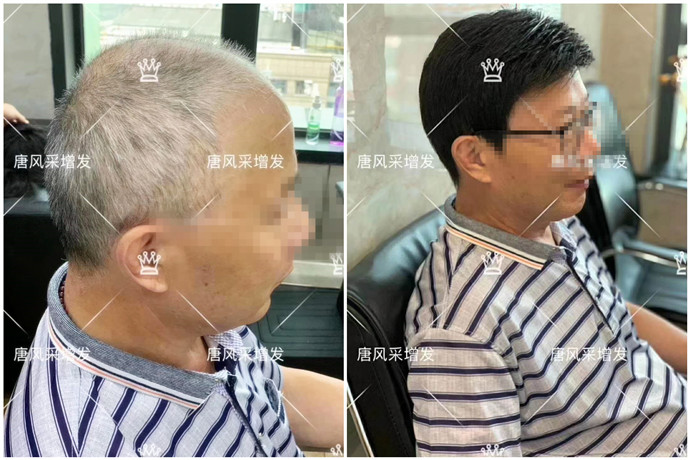 定制隱形假發(fā) \