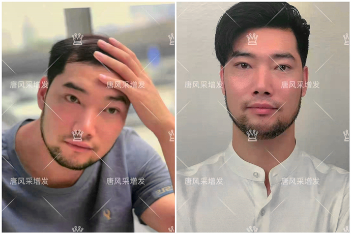 隱形男士假發(fā) \