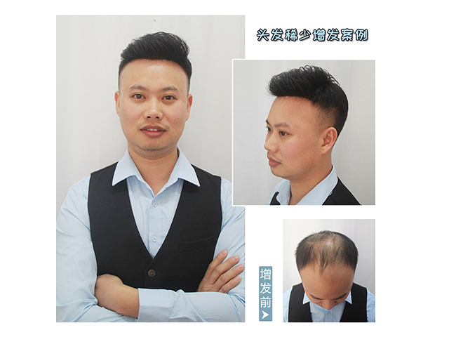 隱形男士補發(fā)塊 \