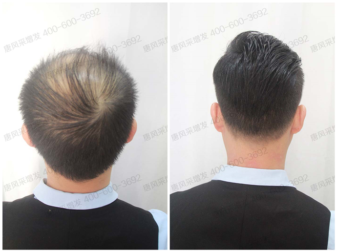 隱形男士補發(fā)塊 \