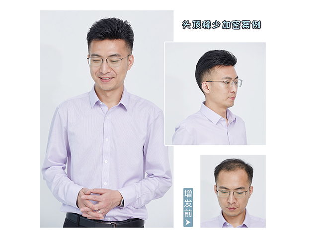 蓋頭頂男士假發(fā)片 \