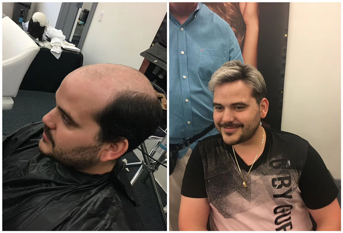 隱形增發(fā)對比照 \