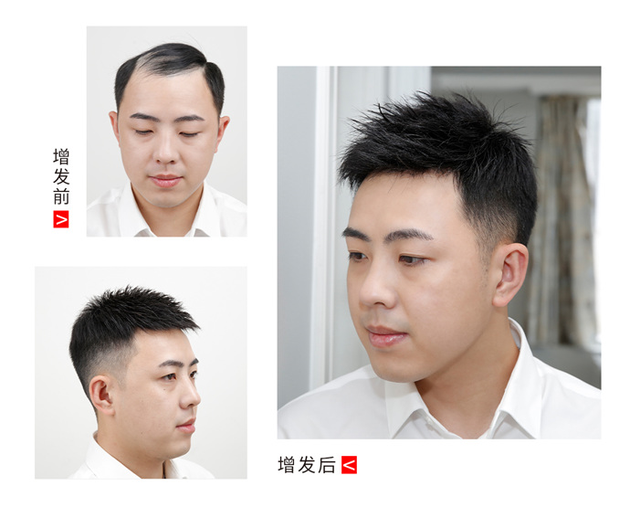 隱形男士假發(fā)