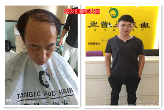 蓋頭頂粘貼假發(fā) \