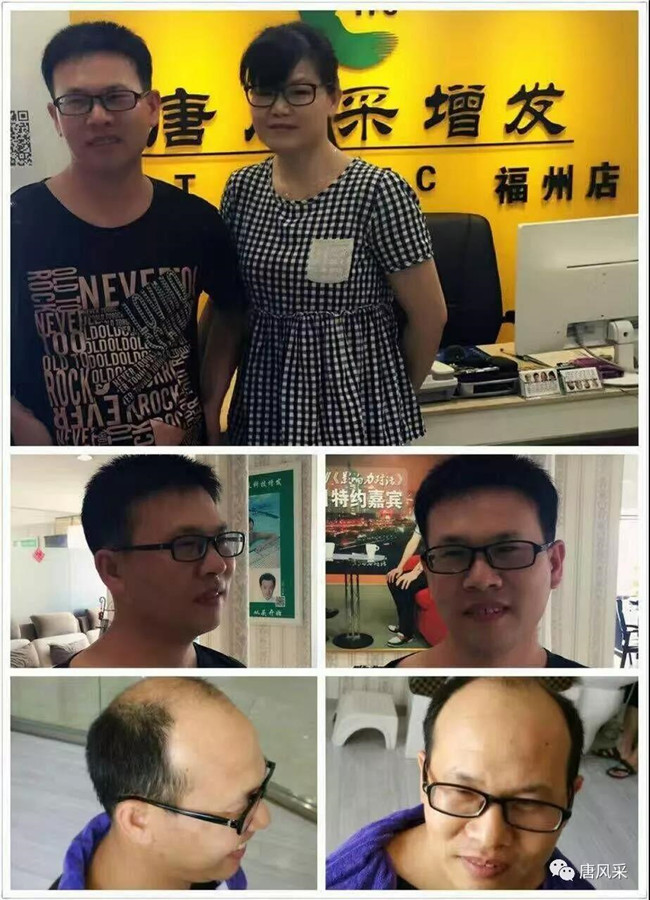 蓋頭頂粘貼假發(fā) \