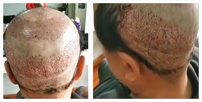 禿頂能移植頭發(fā)么 \