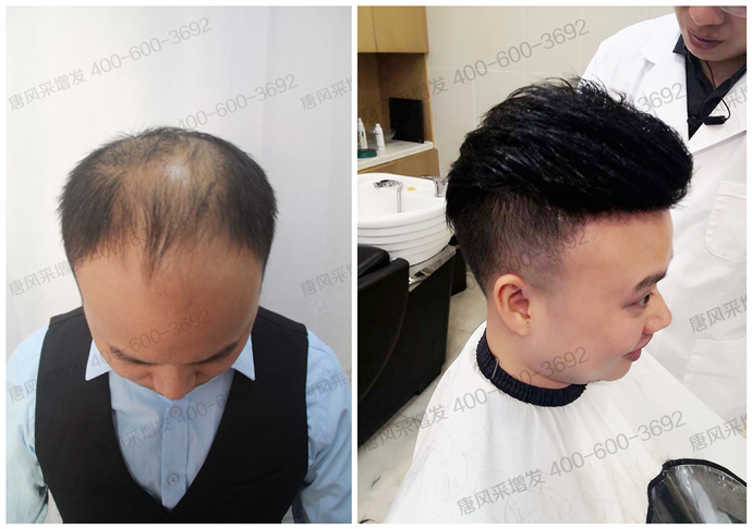 禿頂能移植頭發(fā)么 \