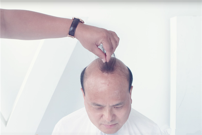 織發(fā)補(bǔ)發(fā)的優(yōu)勢(shì) \