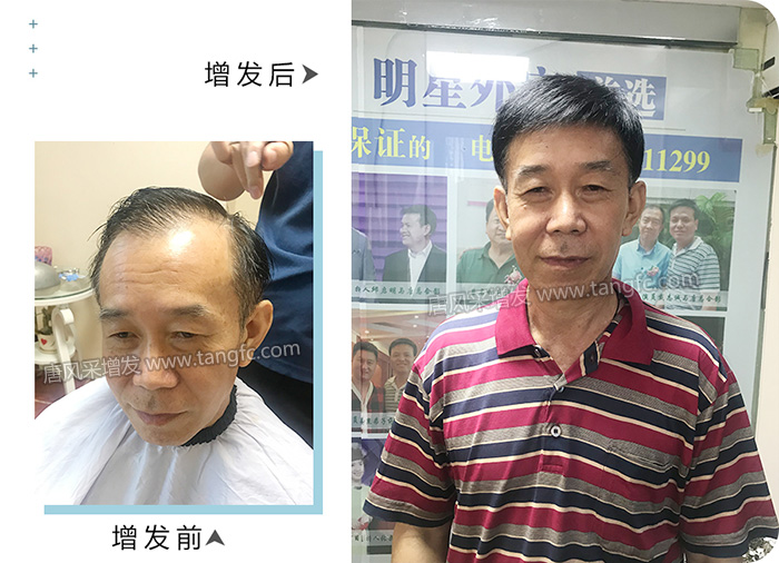 頭頂補發(fā)假發(fā)片 \