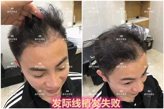 男士隱形補發(fā)哪家好 \