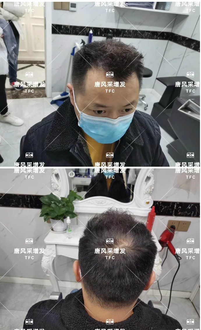 男士頭頂假發(fā)片效果好嗎 \