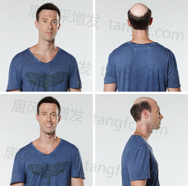 男士假發(fā)可以用多久 \