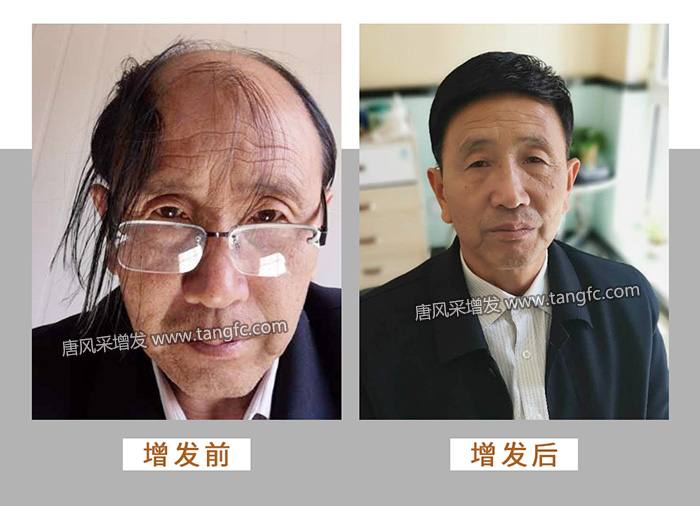 唐風(fēng)采定制局部假發(fā) \