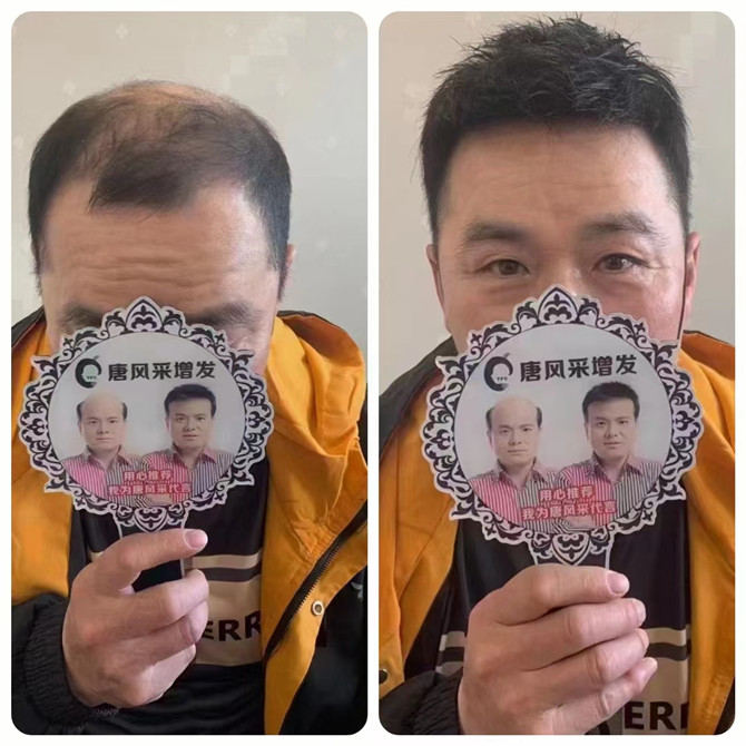 局部隱形補發(fā)假發(fā) \