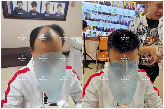 局部隱形補發(fā)假發(fā) \