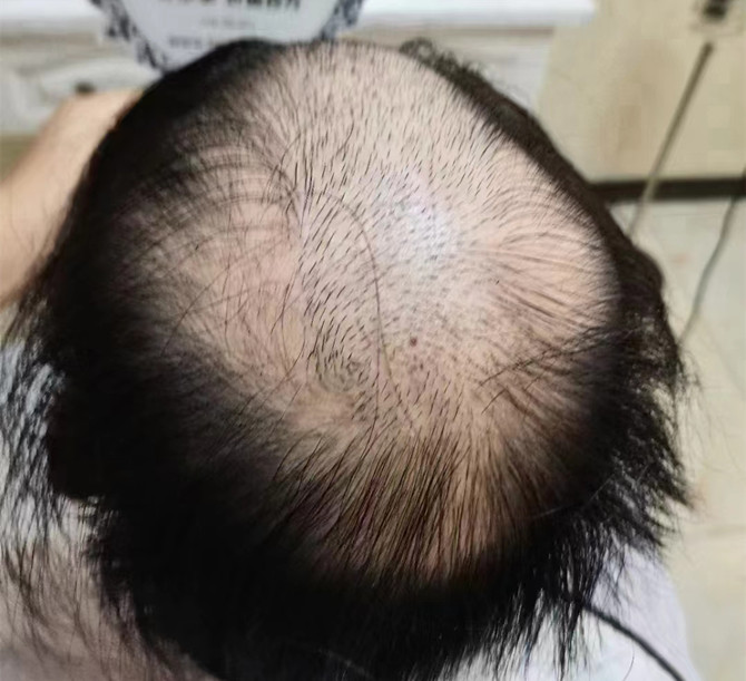 禿頭假發(fā)片 \