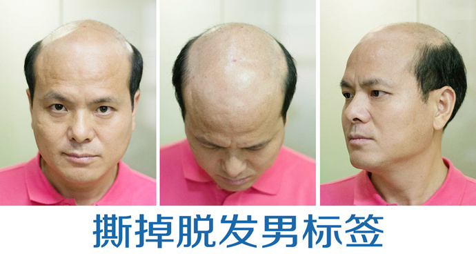 男士隱形補發(fā) \