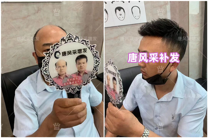 男士隱形補發(fā) \