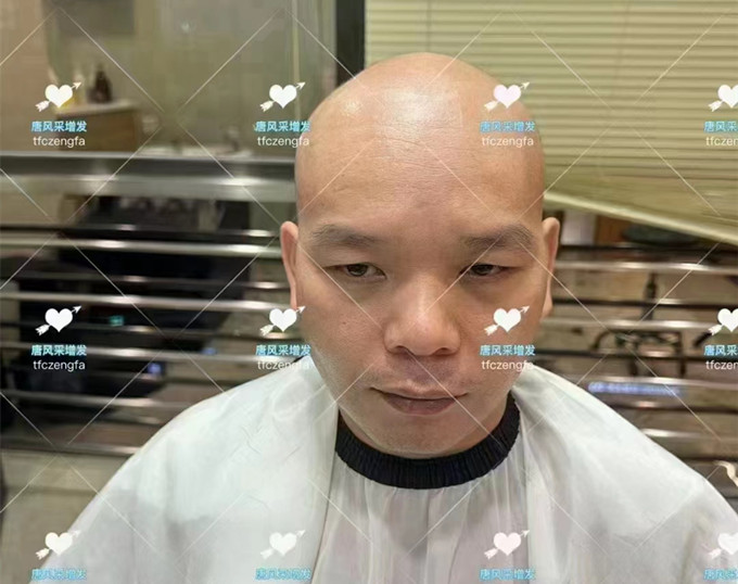 頭頂頭發(fā)稀疏 \